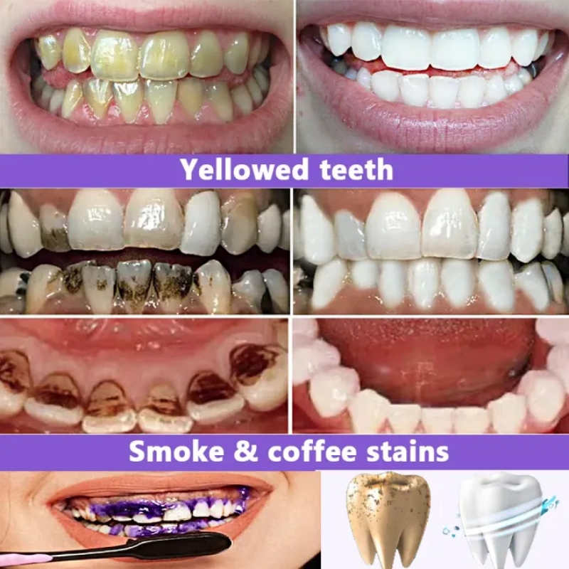 Dentifrice blanchissant best-s - Teeth Whitening Effective avis et prix