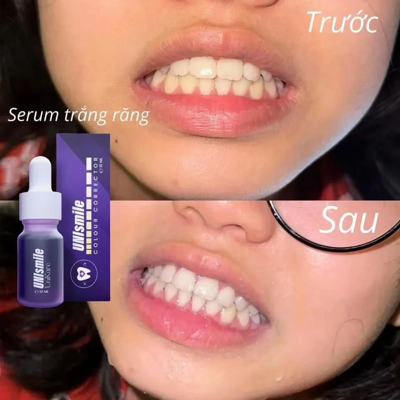 Unismile Essence de blanchimen - Teeth Whitening Effective avis et prix