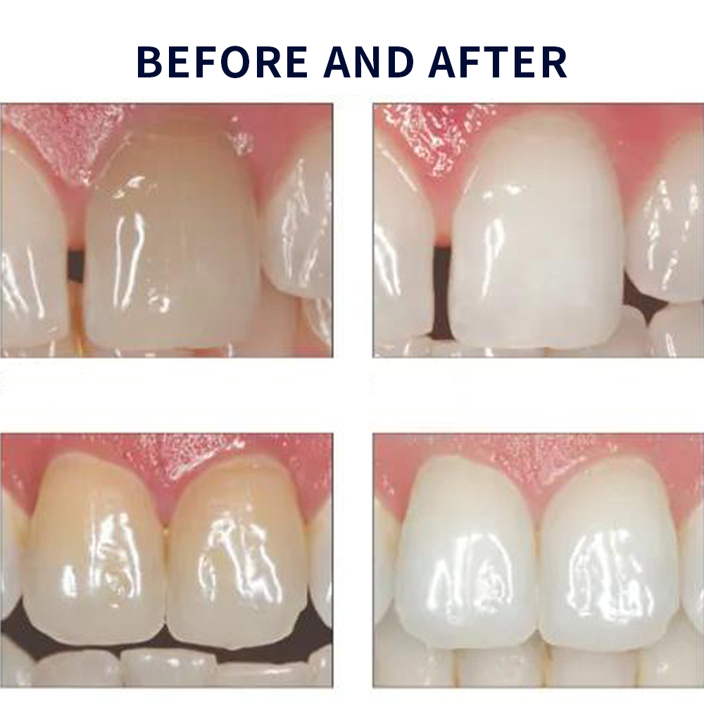 Opalwisdom-Kit de Blanchiment  - Teeth Whitening Remedies avis et prix