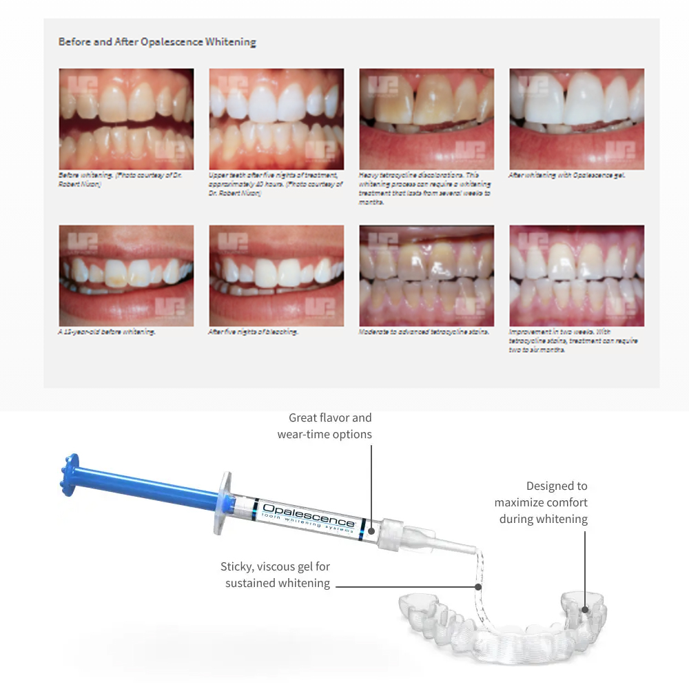 Opalwisdom-Kit de Blanchiment  - Teeth Whitening Remedies avis et prix