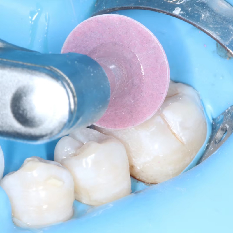 40 disques de polissage dentai - Teeth Whitening Home avis et prix