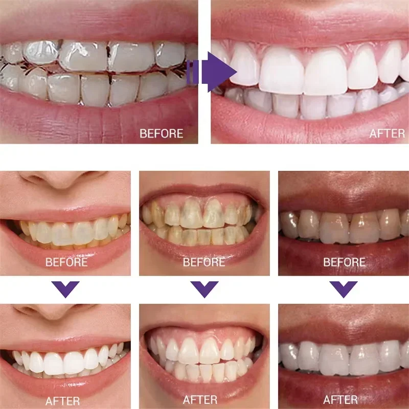 Nettoyage des dents dentifrice - Teeth Whitening Korea avis et prix