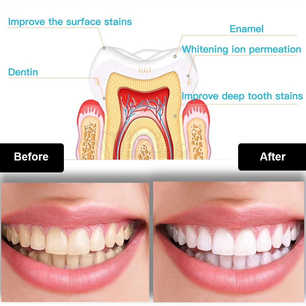 Kit de blanchiment des dents d - Teeth Whitening Gel Peroxide avis et prix